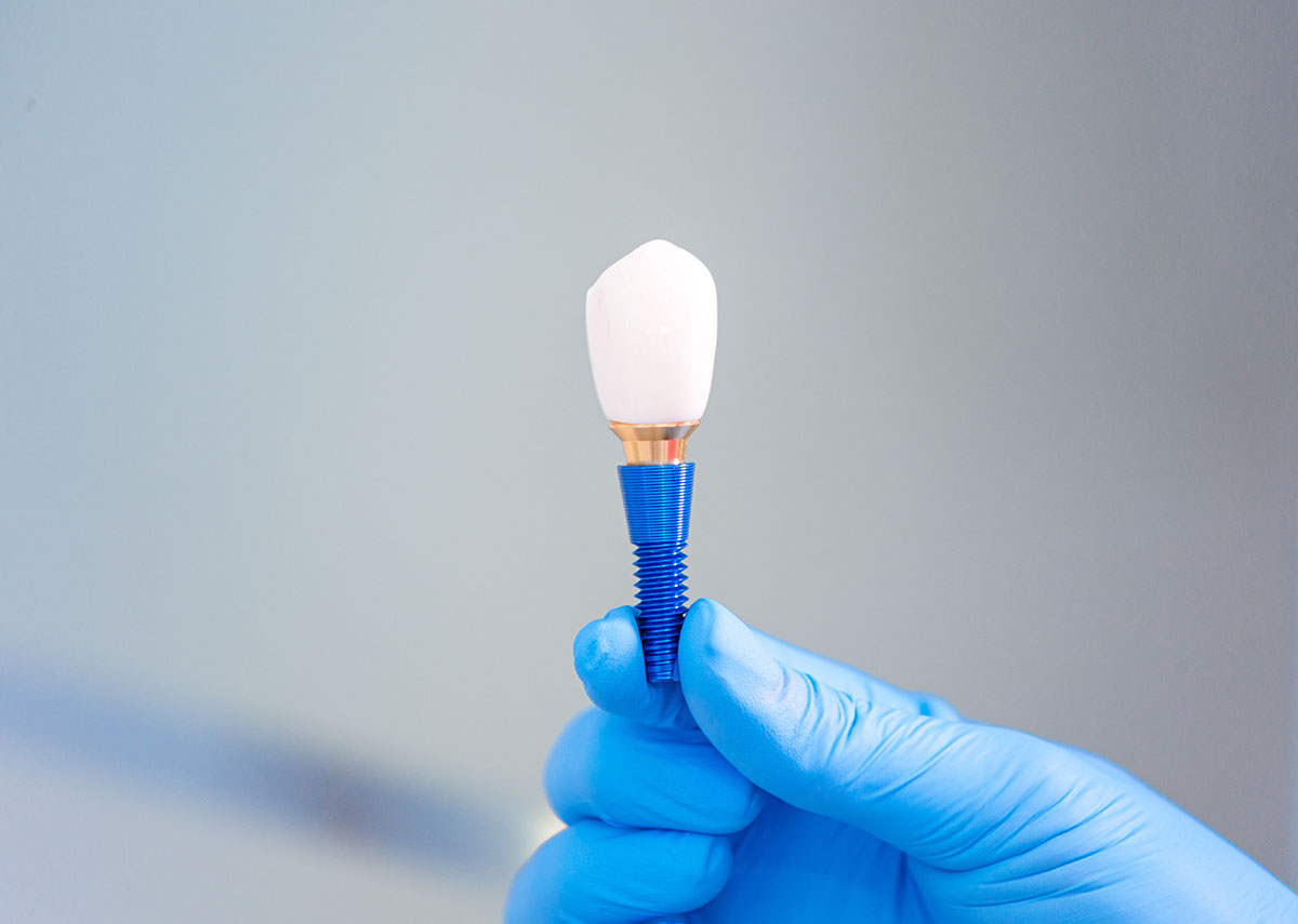 Doctor,Holding,Dental,Titanium,Teeth,Implant,Artificial,Tooth,Root,Screw