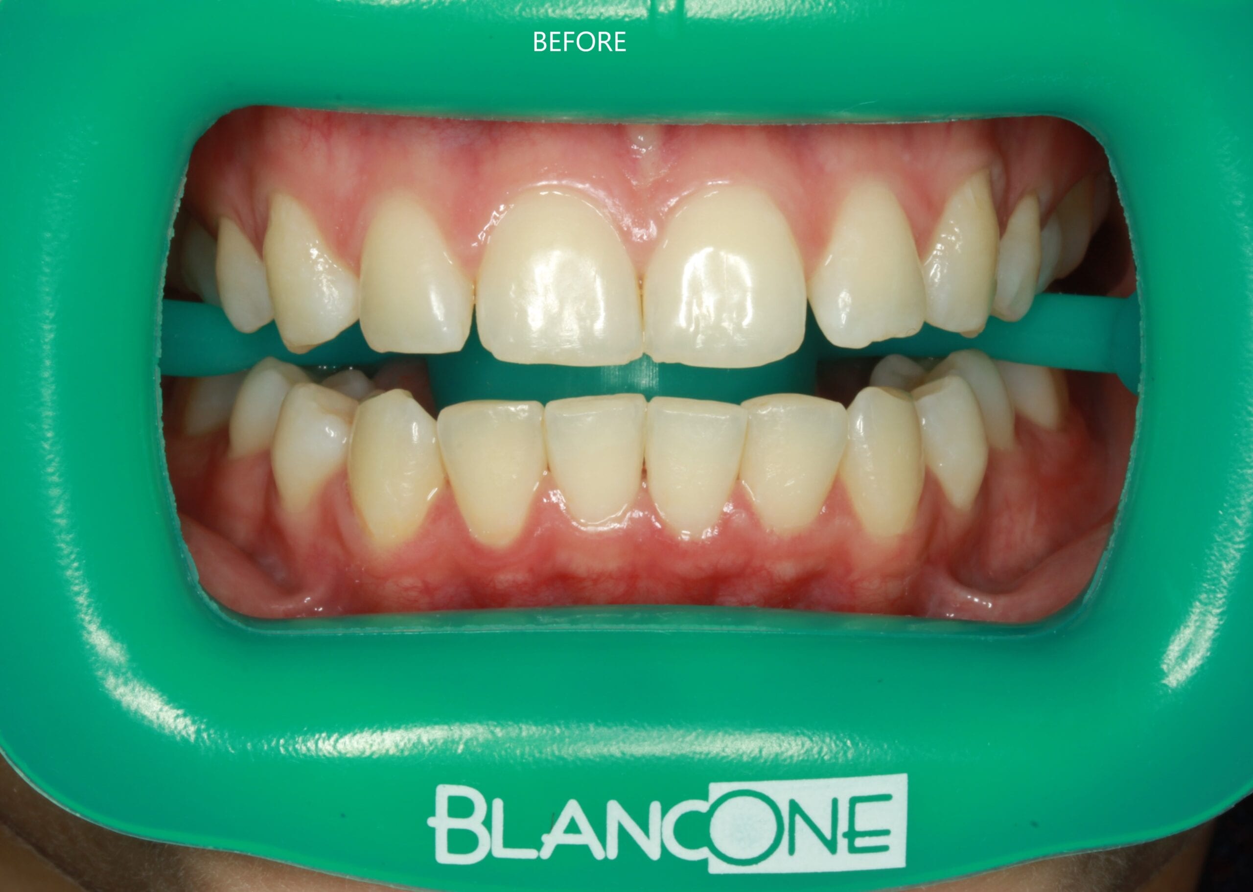 Before tooth whitening treatment - Wynberg Dentistry