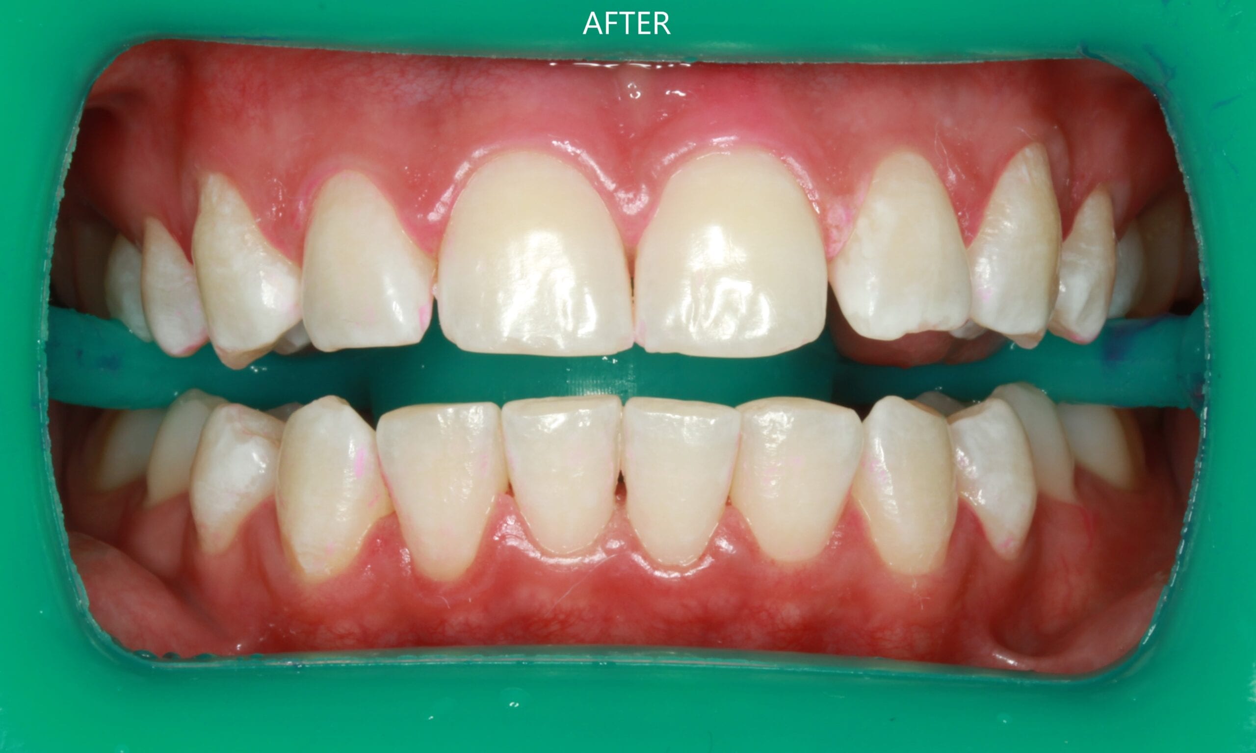After tooth whitening treatment - Wynberg Dentistry