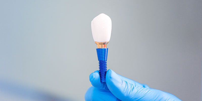 home implant Wynberg Dentistry Home